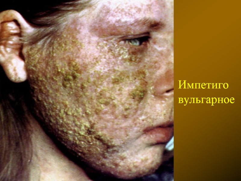 Импетиго вульгарное